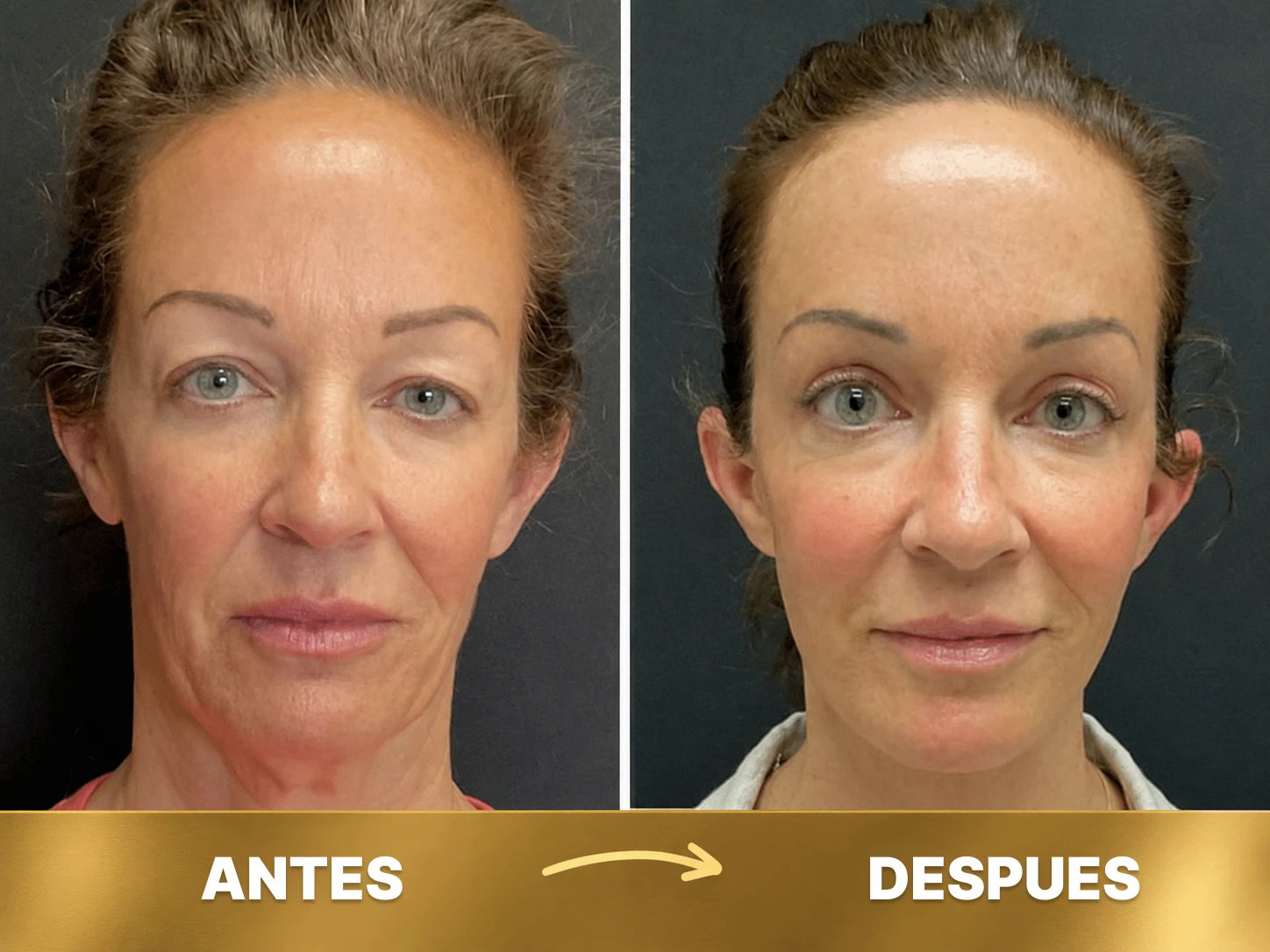 Antes y después 1